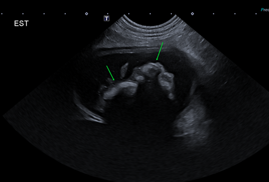 Corps étranger gastrique