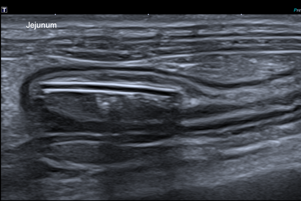 Corps étranger subobstructif